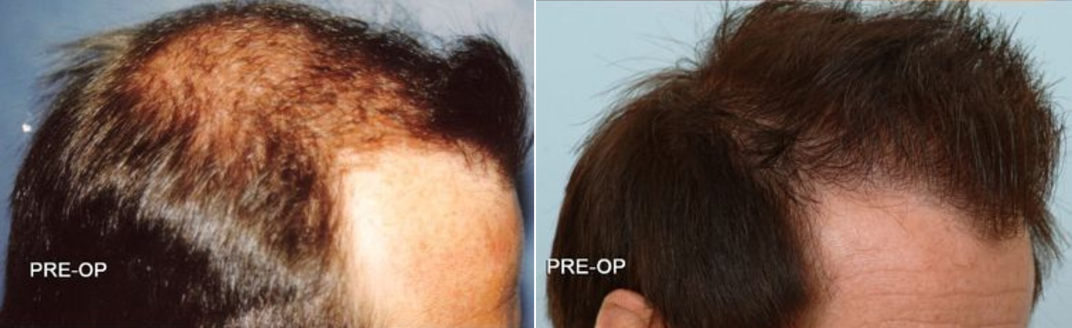 Hair Transplant 1500 grafts FUE