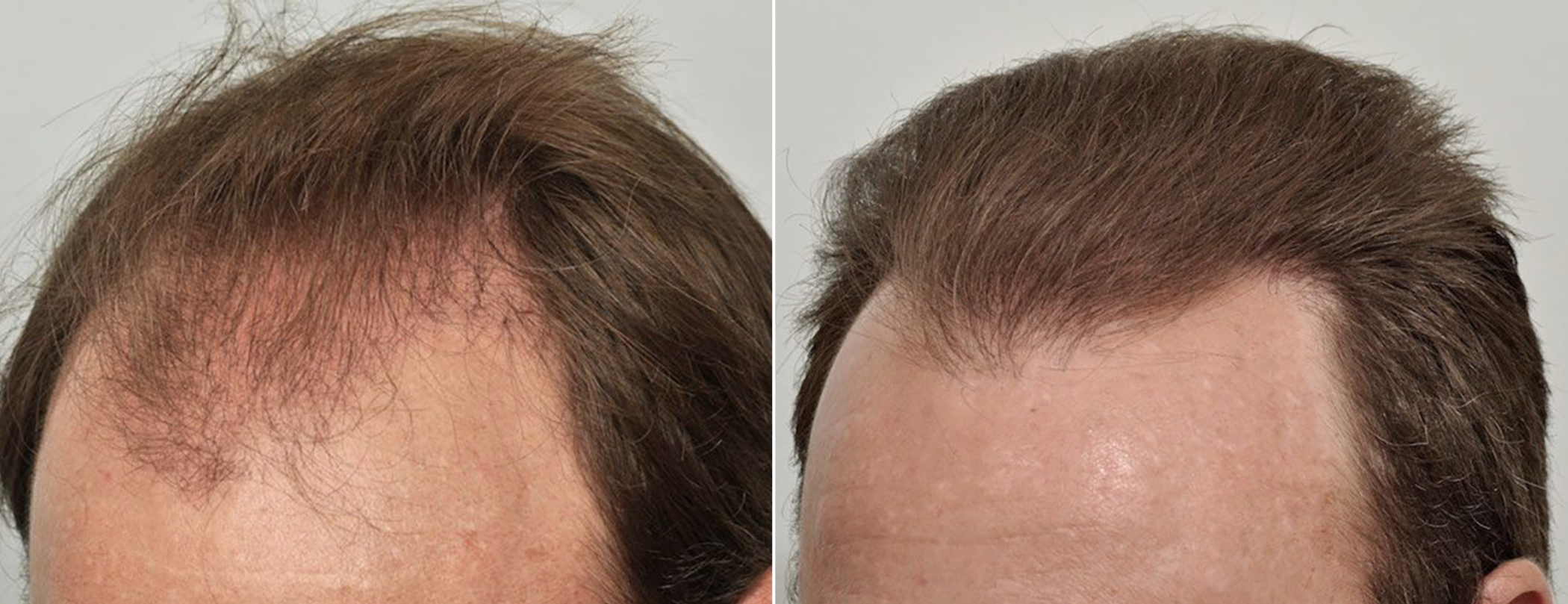 Hair Transplant 4698 grafts FUE