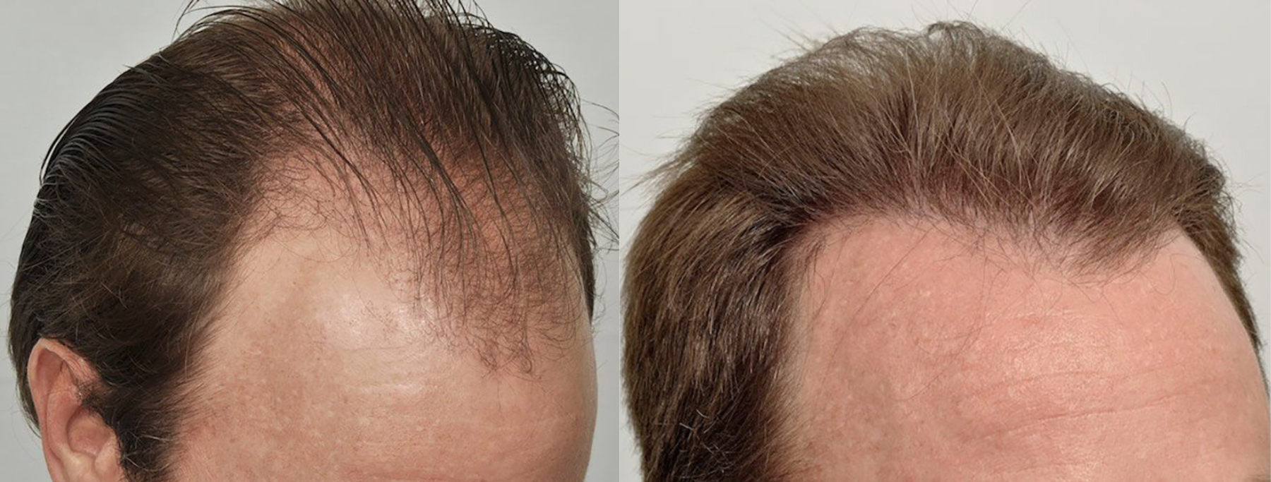 Hair Transplant 4698 grafts FUE