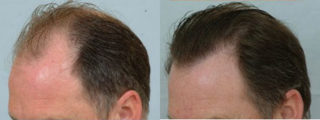 Hair Transplant 3129 grafts FUE