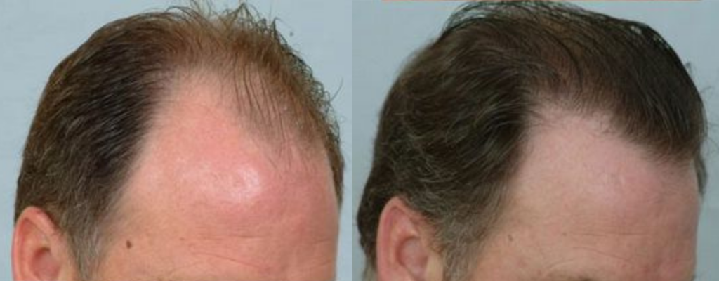 Hair Transplant 3129 grafts FUE