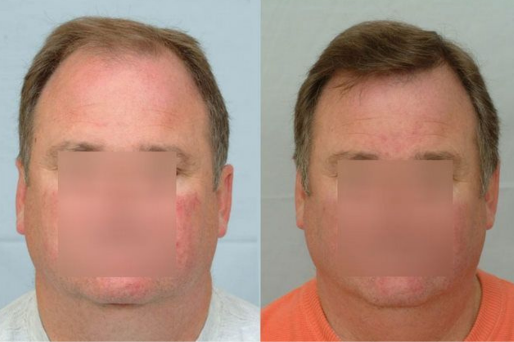 Hair Transplant 3129 grafts FUE