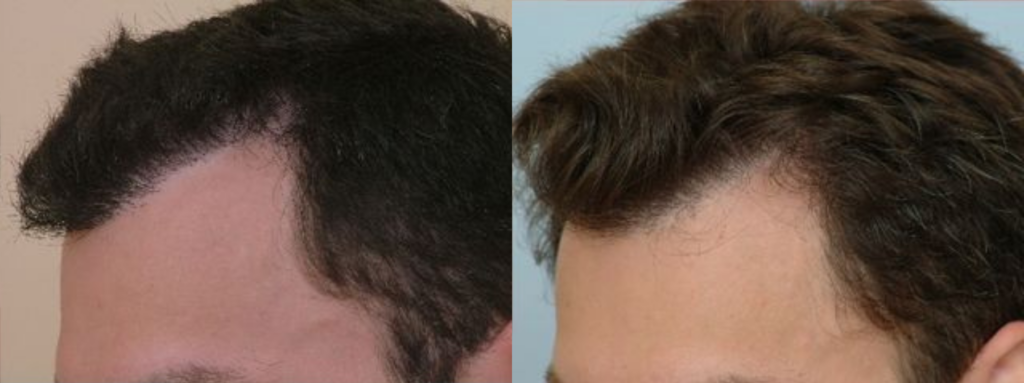Scalp Repair 2300 grafts FUE