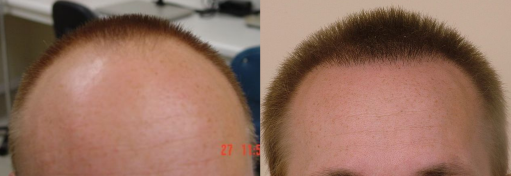 Hair Transplant 2040 grafts FUE