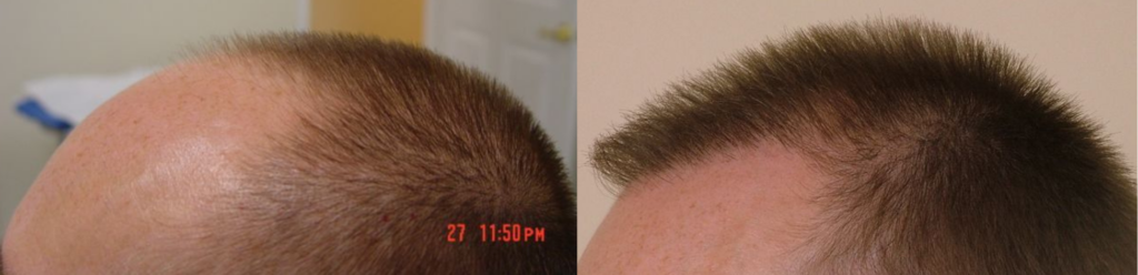 Hair Transplant 2040 grafts FUE