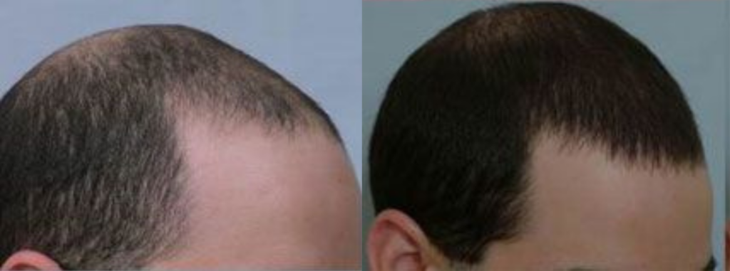 Hair Transplant 2098 grafts FUE