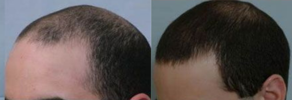 Hair Transplant 2098 grafts FUE