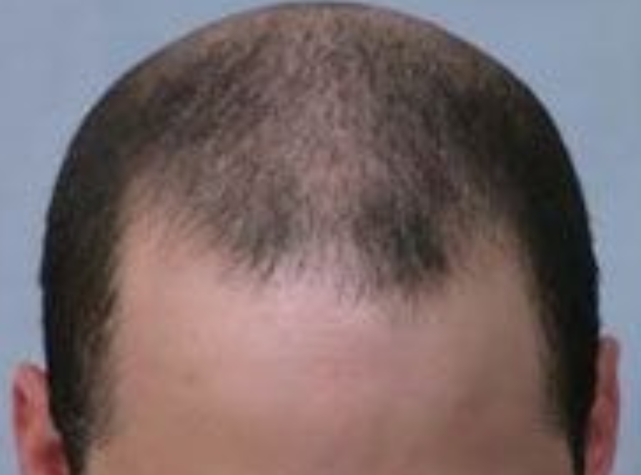 Hair Transplant 2098 grafts FUE