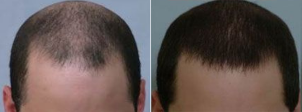 Hair Transplant 2098 grafts FUE