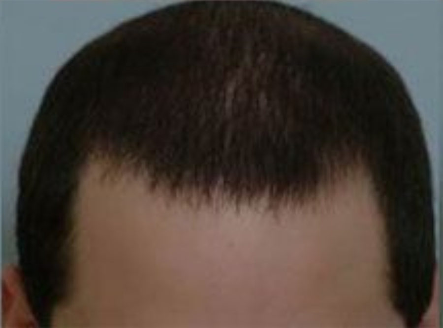 Hair Transplant 2098 grafts FUE