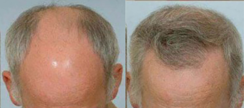 Hair Transplant 6102 grafts FUE