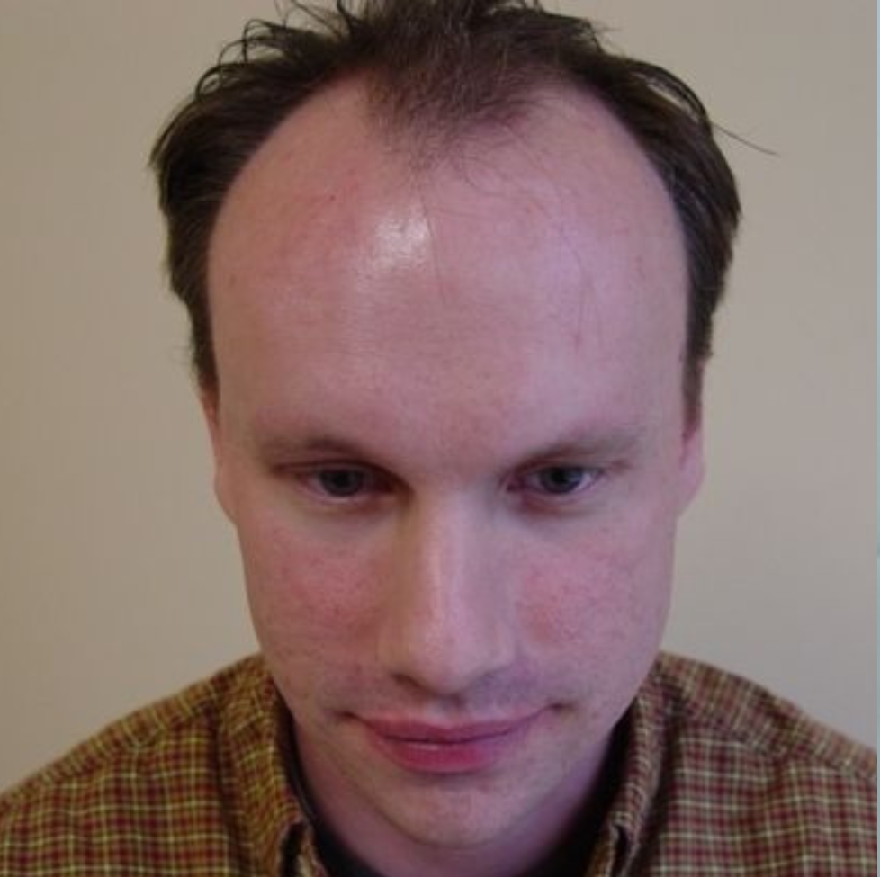 Hair Transplant 2001 grafts FUE