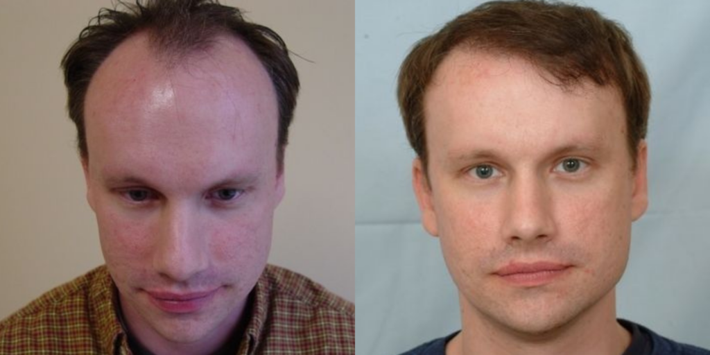 Hair Transplant 2001 grafts FUE