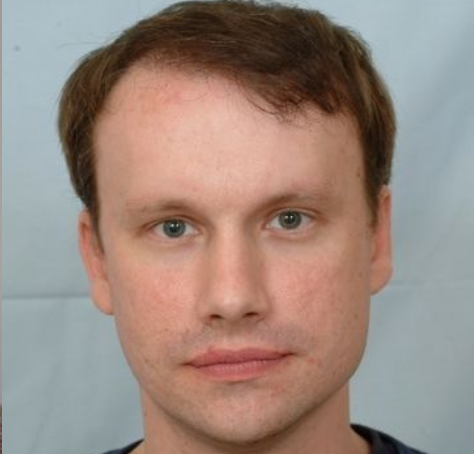 Hair Transplant 2001 grafts FUE