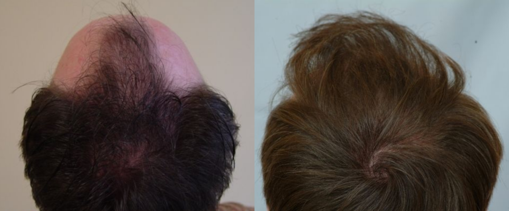 Hair Transplant 2001 grafts FUE