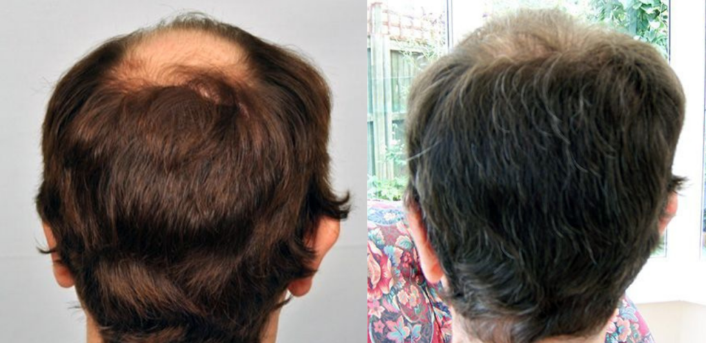 Hair Transplant 4289 grafts FUE