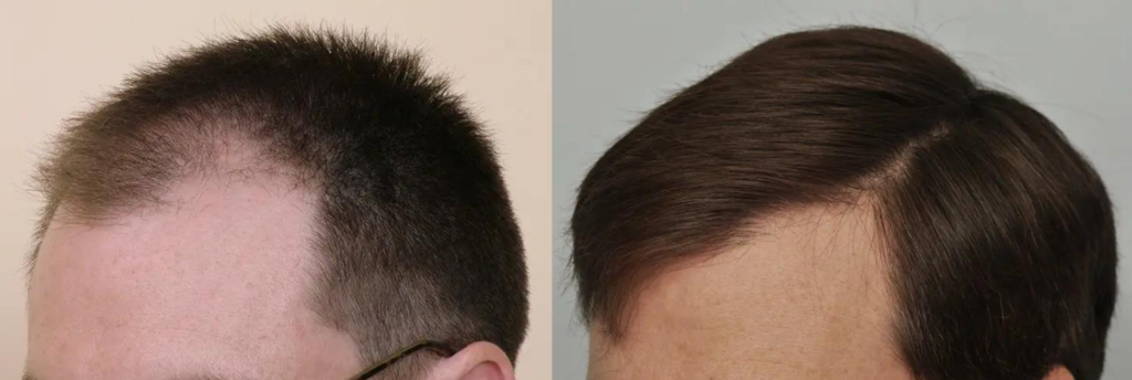Hair Transplant 1845 grafts FUE