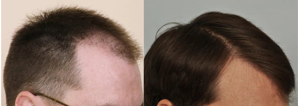 Hair Transplant 1845 grafts FUE