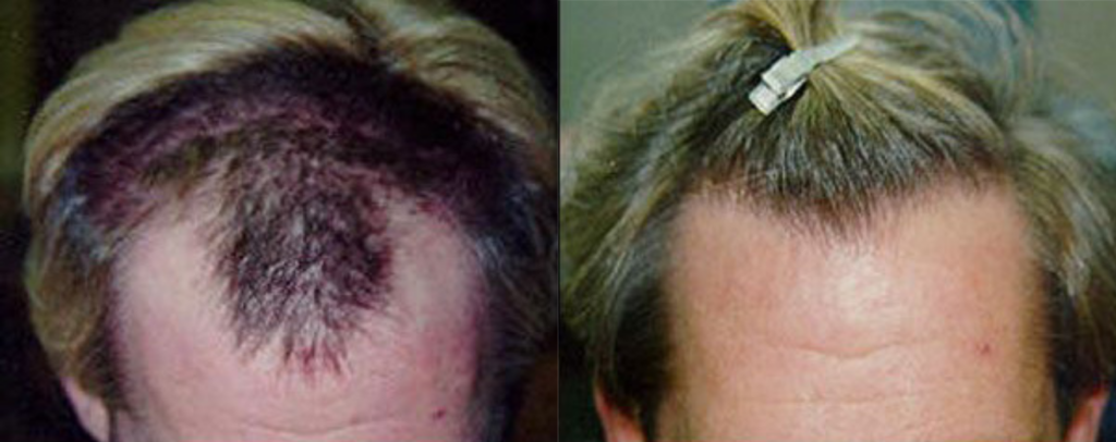 Hair transplant 1500 grafts FUE top2