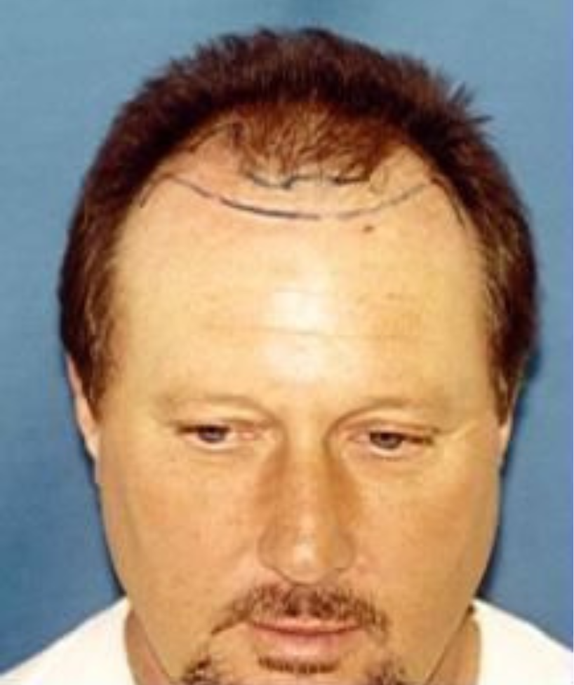 Hair Transplant 4000 grafts FUT