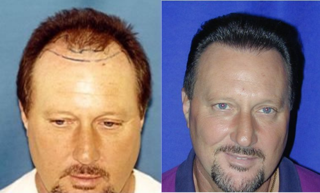 Hair Transplant 4000 grafts FUT