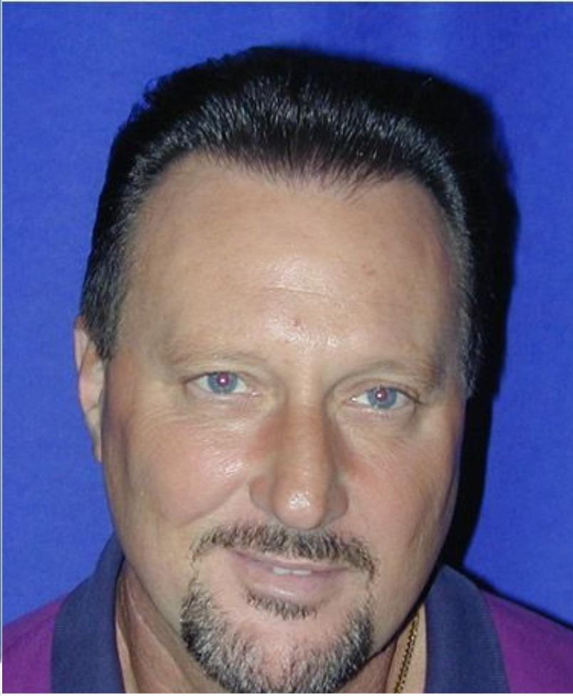 Hair Transplant 4000 grafts FUT