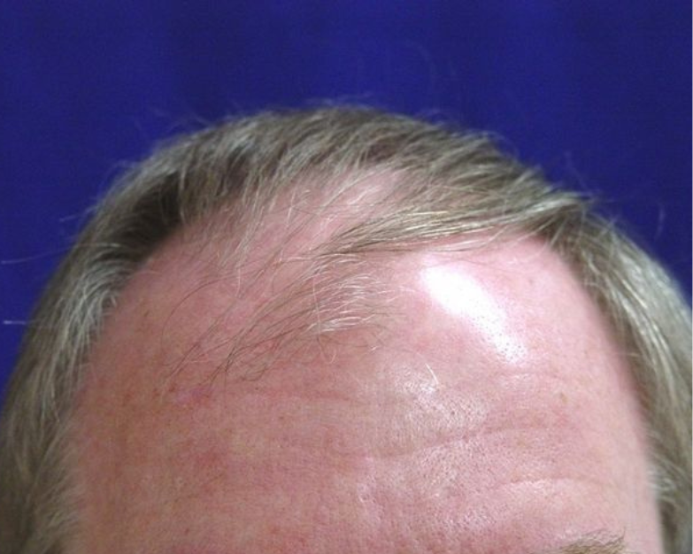 Hair Transplant 2501 grafts FUT