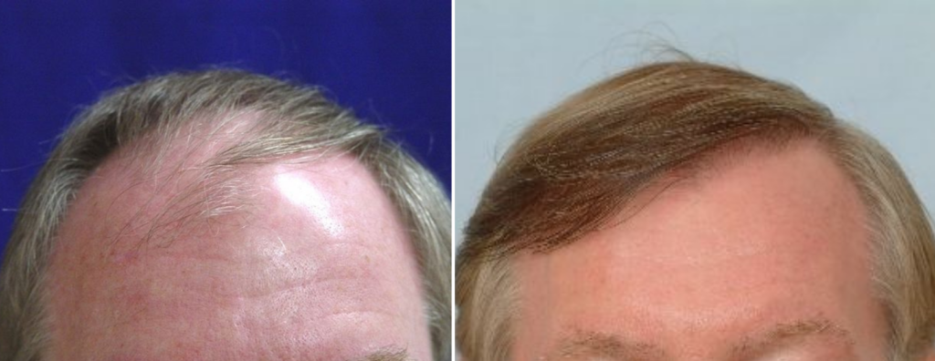 Hair Transplant 2501 grafts FUT