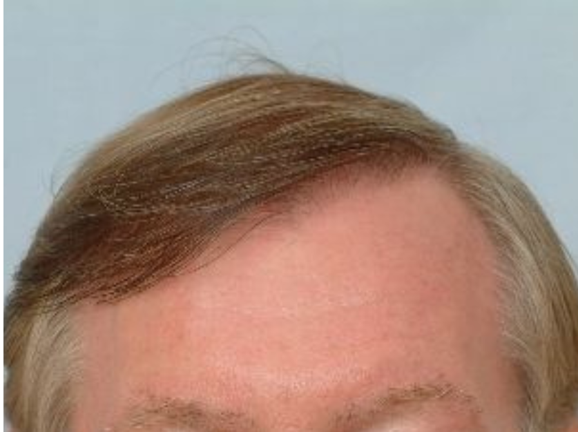 Hair Transplant 2501 grafts FUT