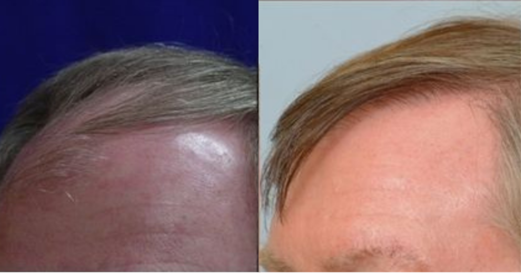 Hair Transplant 2501 grafts FUT