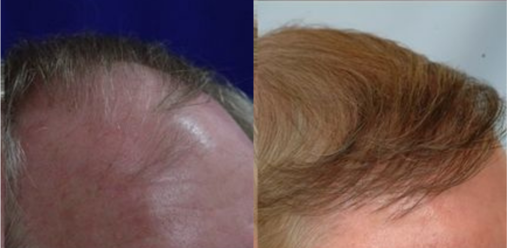 Hair Transplant 2501 grafts FUT