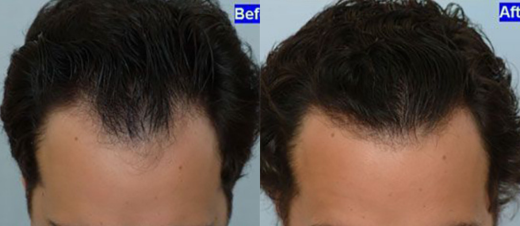 Hair Transplant 1102 grafts FUE
