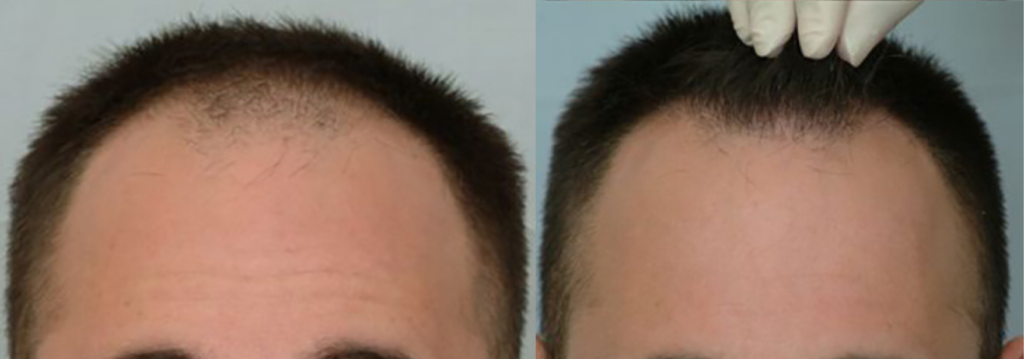 Hair Transplant 700 grafts FUE