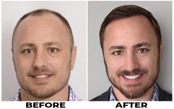Hair Transplant 2833 grafts FUE