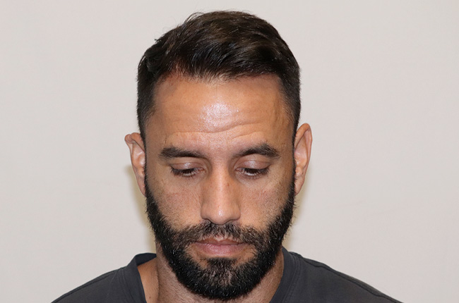 Hair Transplant 2930 grafts FUE featured