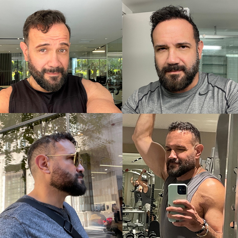 Hair transplant 4200 grafts FUE collage