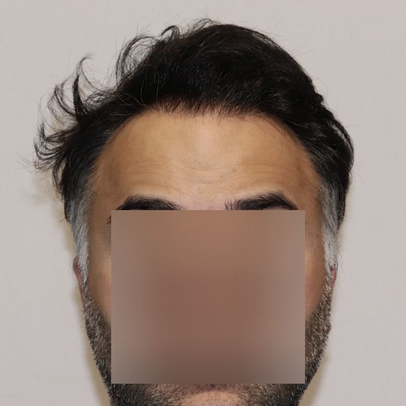 Hair Transplant 3178 grafts FUE