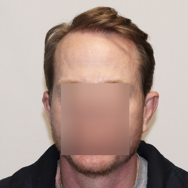 Hair Transplant 3123 grafts FUE