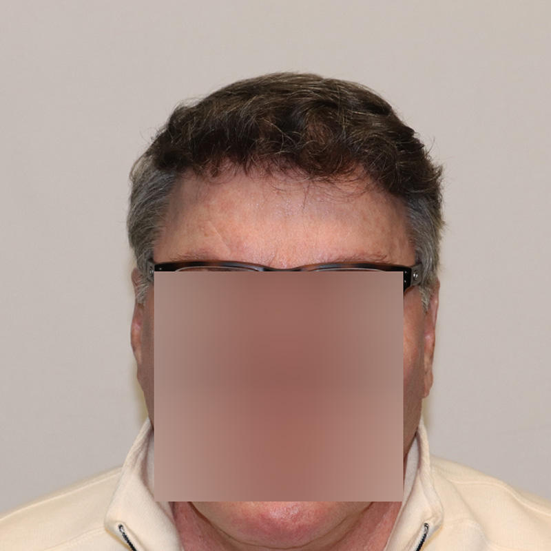 Hair Transplant 2882 grafts FUE