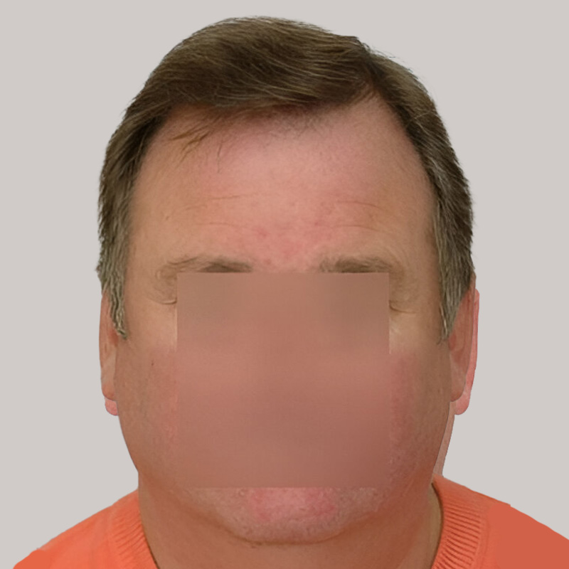 Hair Transplant 3129 grafts FUE