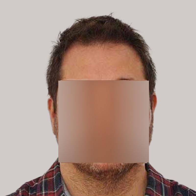 Hair Transplant 2202 grafts FUE