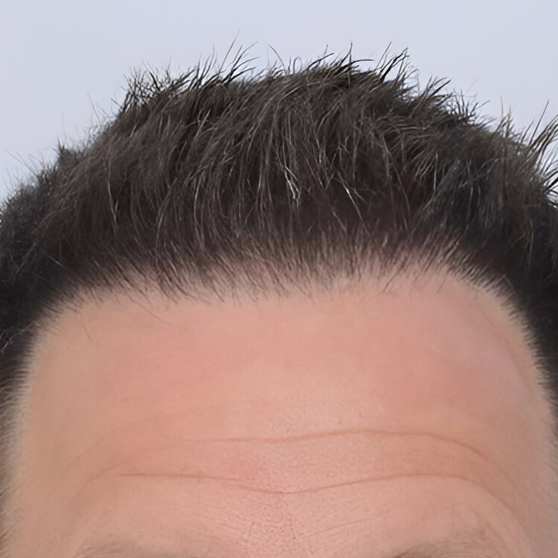 Hair Transplant 2201 grafts FUE