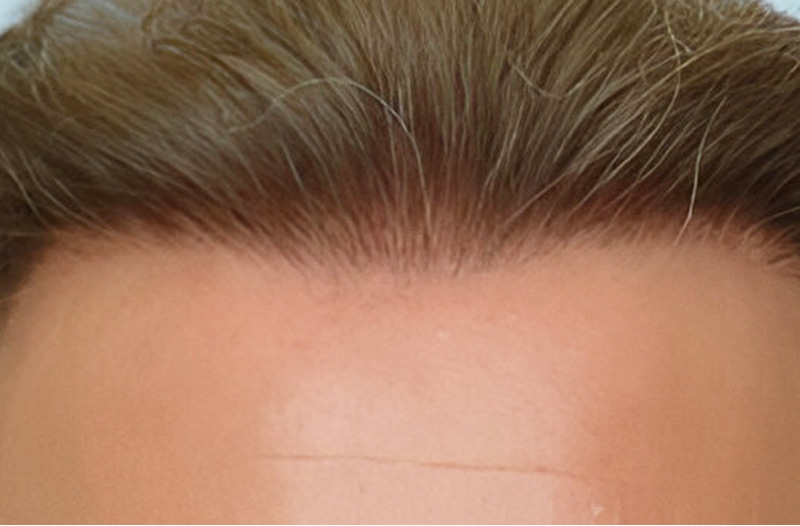 Hair Plug Redistribution 541 grafts