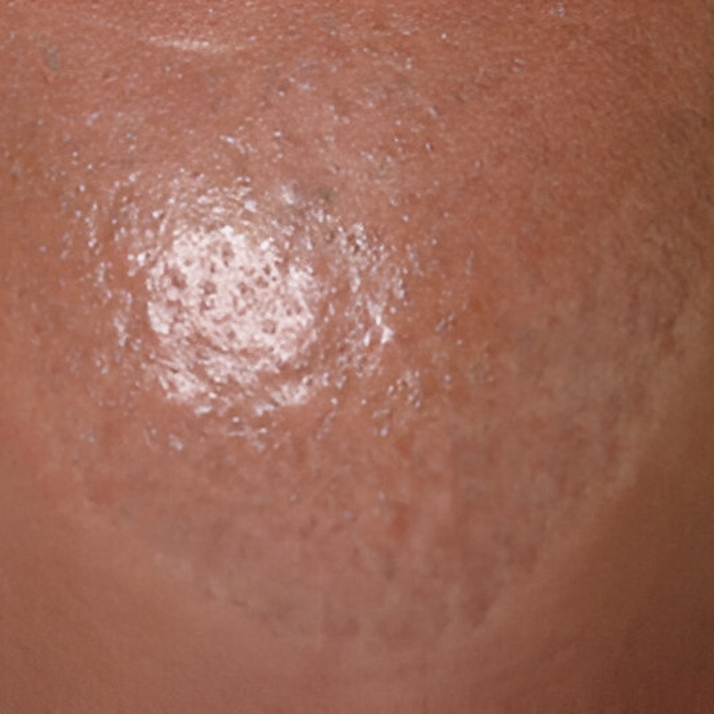 Hair Plug Removal