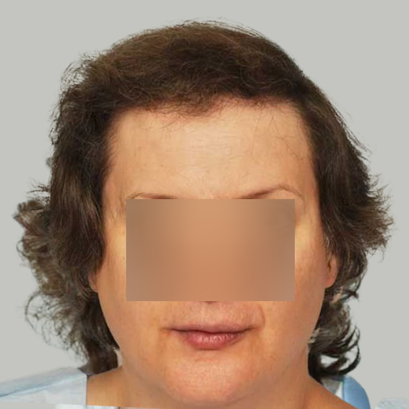 Hair Transplant 3200 grafts FUE