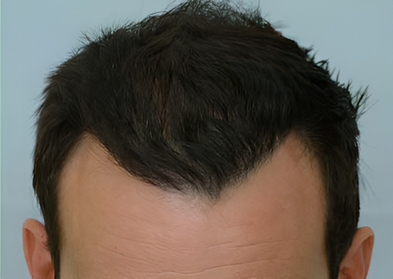 Scalp Repair 3951 grafts FUE