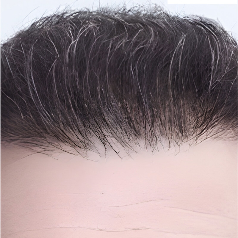 Hair Transplant 2700 grafts FUE