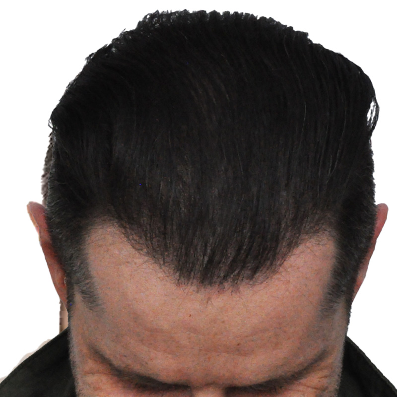 Hair transplant 3957 grafts FUE