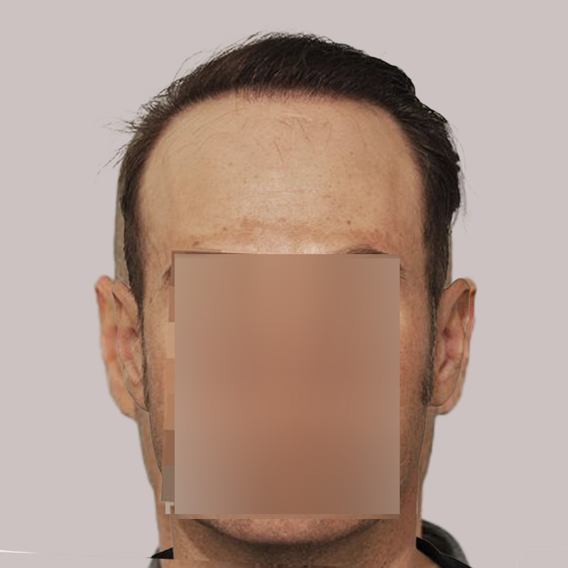 Hair Transplant 3605 grafts FUE