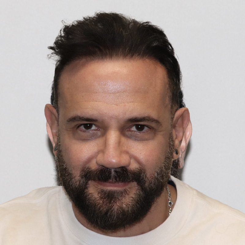 Hair Transplant 4200 grafts FUE